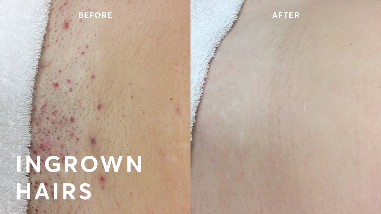 before and after ingrown hairs